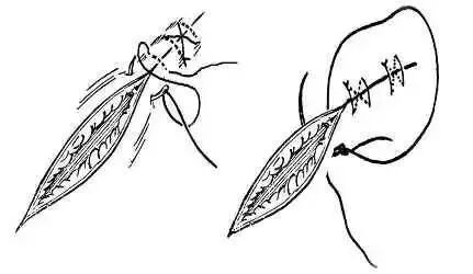 为什么要用皮钉缝合图文并茂丨外科各种缝合方法详解_https://www.jmylbn.com_新闻资讯_第4张