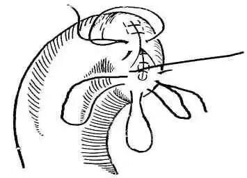 为什么要用皮钉缝合图文并茂丨外科各种缝合方法详解_https://www.jmylbn.com_新闻资讯_第12张