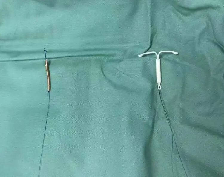 达到避孕目的，又能达到很好的治疗子宫腺肌症效果。▼吉妮环和曼月乐环