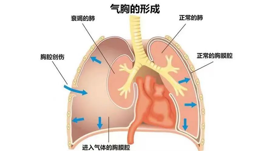 开放性气胸示意图图片