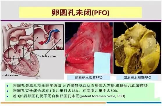 濮阳市油田总医院卵圆孔未闭可引发脑卒中的先心病