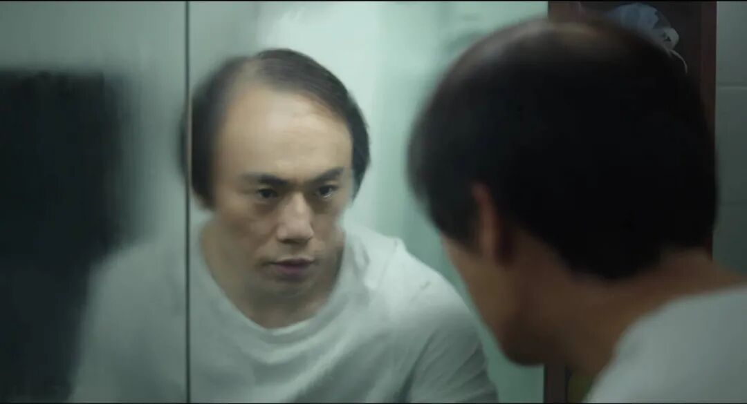 头皮结痂又抠掉又结痂怎么治 自从我植发后，才发现年轻人对于脱发有多焦虑