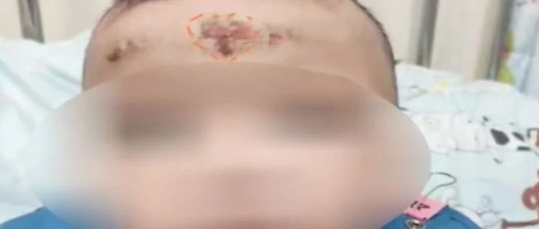 10个月婴儿面部溃烂！竟是外婆一个动作导致！医生紧急提醒
