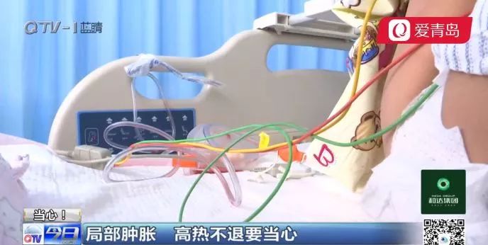 青島6歲男孩扭傷腳踝，卻住進重症室！高燒、肺膿腫…致死率全球第三 健康 第7張