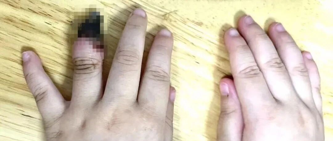 痛心！家人错误包扎致3岁女童被截指，创可贴要这么用！