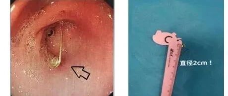 凶险！青岛8个月宝宝“开口别针”进肚内！这些“夺命玩具”千万别碰……