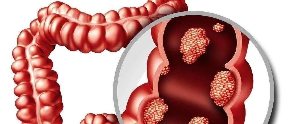 结直肠癌全基因组关联分析研究进展及展望