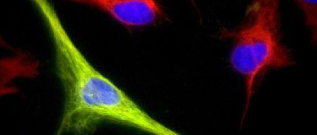 DC与CIK共培养对骨肉瘤细胞的杀伤作用