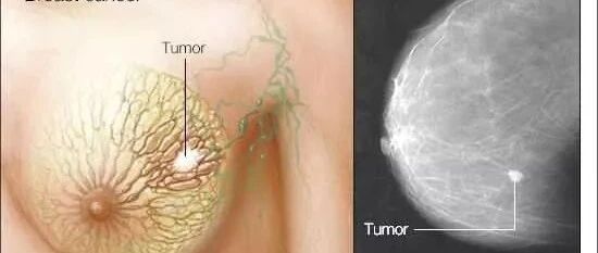 说一说关于乳房健康的五个谣言