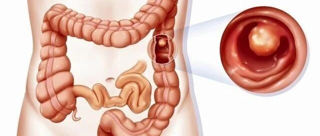 哪些人是肠癌高危人群？如何进行排查？肠癌有哪些早期信号？肠道疾病患者饮食应注意什么？