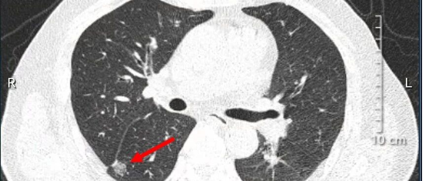 非小细胞肺癌免疫治疗的临床影响因素