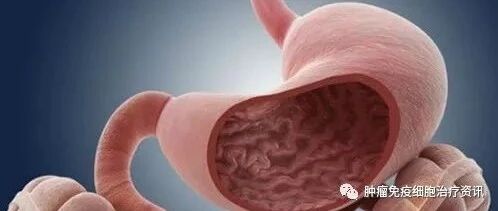 名家告诉你||胃癌的放射治疗