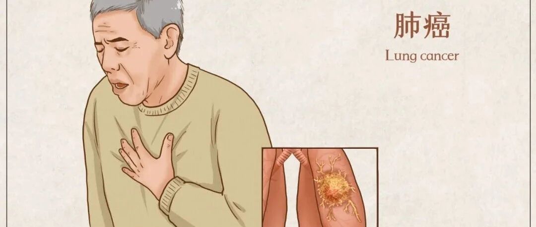 如何发现早期肺癌？