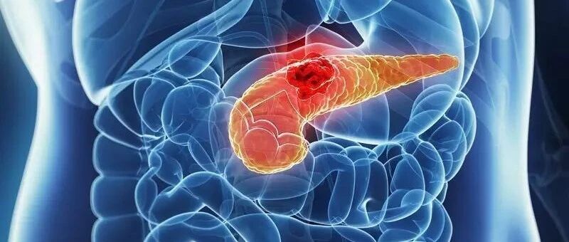 警惕新发糖尿病背后“隐藏”胰腺癌