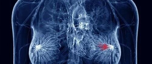 吉西他滨联合奈达铂治疗人表皮生长因子受体2阴性晚期乳腺癌的疗效和安全性