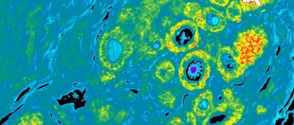 解读肺癌病理报告（一）