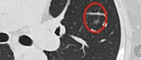 蛰伏六年！肺小结节终于露出真面目！一文教你如何处理肺小结节！