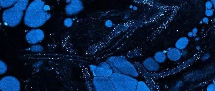 2021 ESMO IO 肺癌领域热点回顾