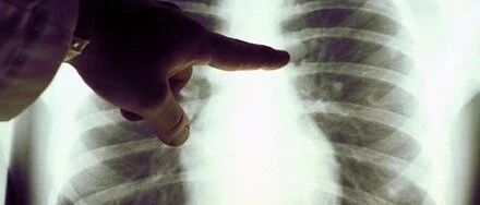 小细胞肺癌多基因组学研究进展