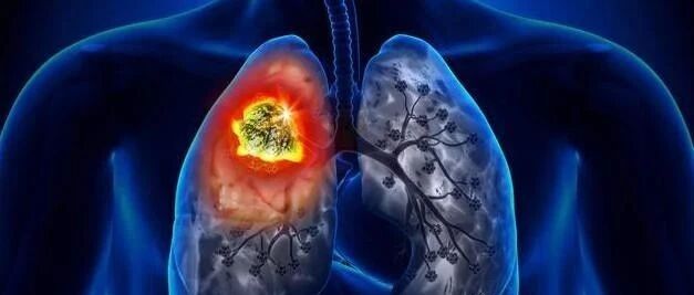 预防性全脑照射治疗非小细胞肺癌的研究进展