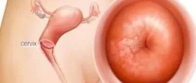 宫颈癌是可以预防的疾病