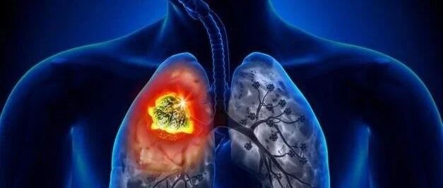 晚期NSCLC患者外周血指标的动态变化与PD-1抑制剂联合治疗疗效之间的相关性