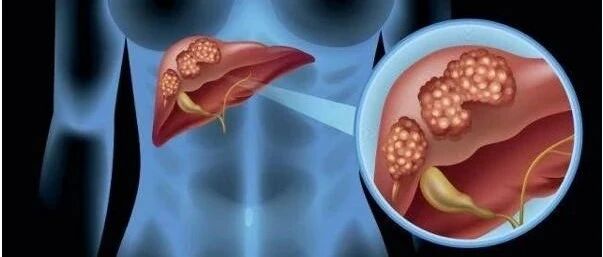 低分化肝细胞癌的免疫微环境及其对PD-1抑制剂疗效的评估价值