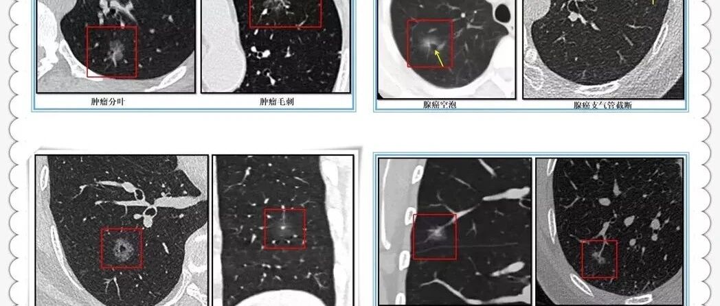 如何正确认识肺结节