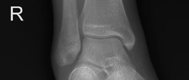 5分钟学会诊断下胫腓联合分离，点赞收藏！