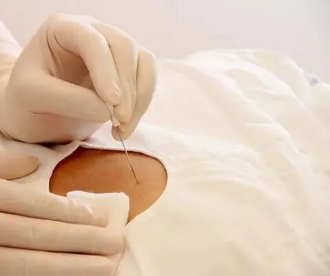 什么是牵引床“小针刀”是什么东西？ 听说它超厉害的！_https://www.jmylbn.com_新闻资讯_第7张