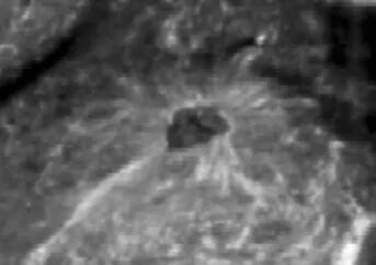 什么是超声容积探头自动乳腺容积超声技术专家共识（2022版）重点摘要_https://www.jmylbn.com_新闻资讯_第10张