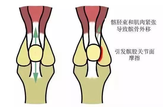 长期膝痛，专家指出：谨防膝关节内侧滑膜皱襞综合征！