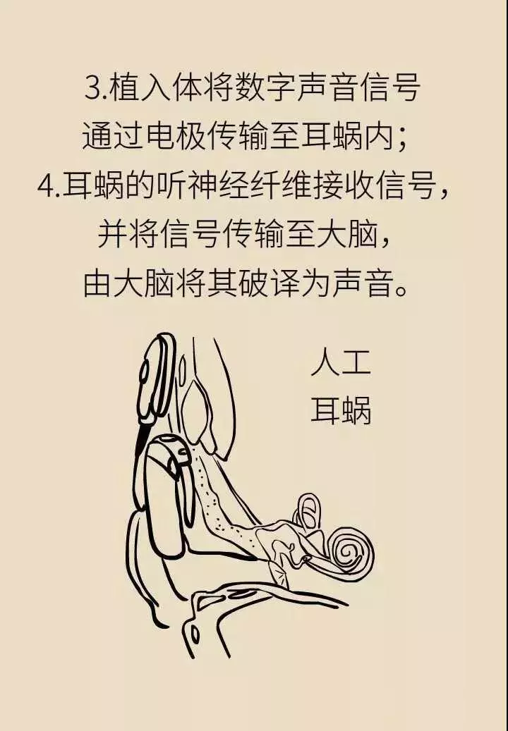 轻松科普|人工耳蜗—酷酷的“小耳朵” 轻松科普|人工耳蜗—酷酷的“小耳朵”