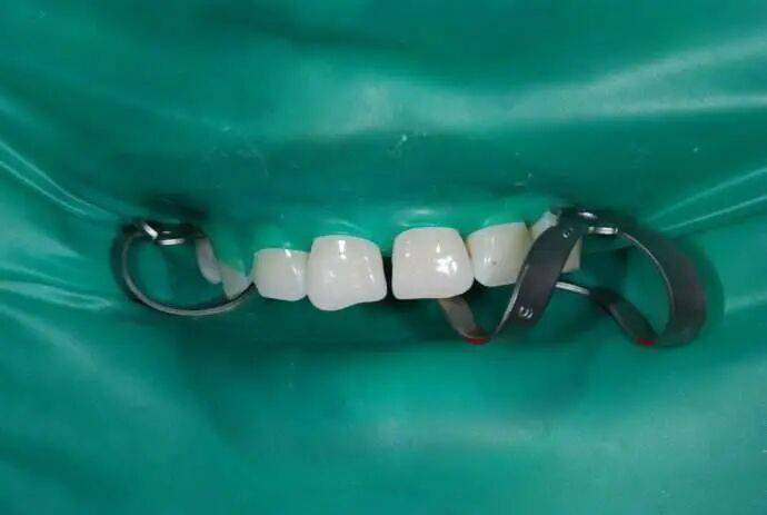 牙科用什么耗材被国家卫健委点名要求加大使用，“物美价廉”的橡皮障为何会成为牙科的“蜜糖与砒霜”？_https://www.jmylbn.com_新闻资讯_第5张