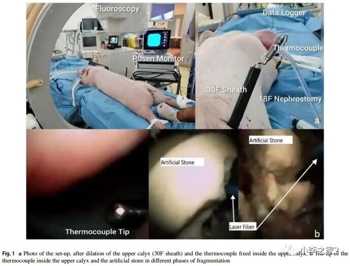 输尿管鞘是什么软镜碎石术中“输尿管鞘+人工灌注”是最安全的方式_https://www.jmylbn.com_新闻资讯_第1张