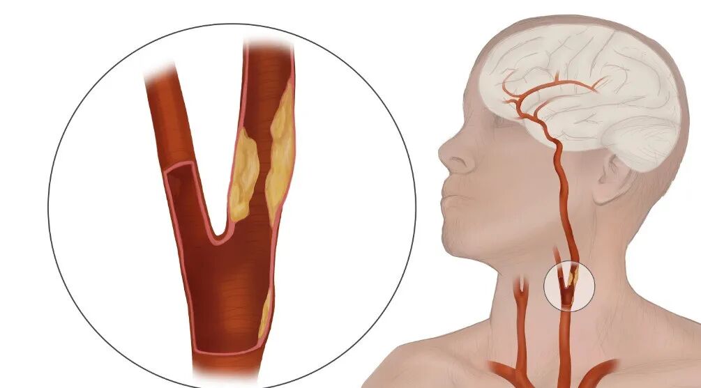医用三氧是什么医用三氧疗法可作为一种新的治疗颈动脉斑块的途径_https://www.jmylbn.com_新闻资讯_第1张