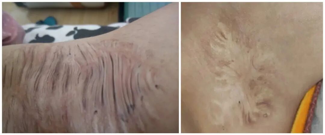 【微创祛腋臭】做了狐臭手术，伤口多大，多久可以恢复？