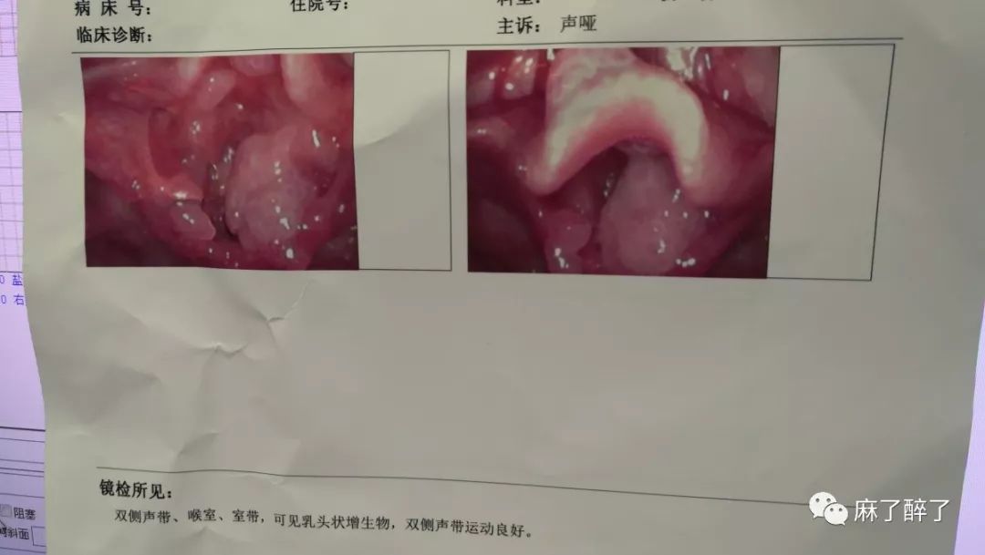 （喉乳头状瘤）第一次央着师父带我做喉乳头状瘤，就遇到一个瘤体几乎长