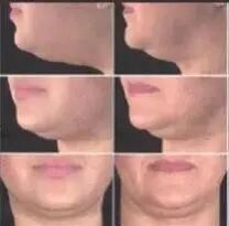 国内首支“祛双下巴针”进入Ⅲ期临床研究，你心动了吗？