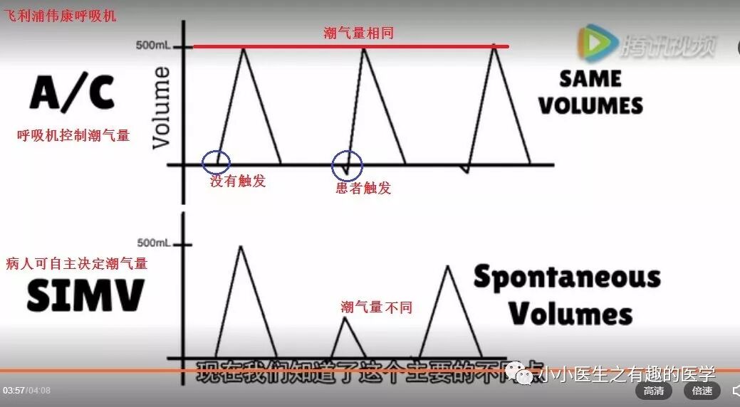 呼吸机ac是什么意思呼吸机：SIMV与AC模式的区别，不讲区别的都是耍流氓_https://www.jmylbn.com_新闻资讯_第12张