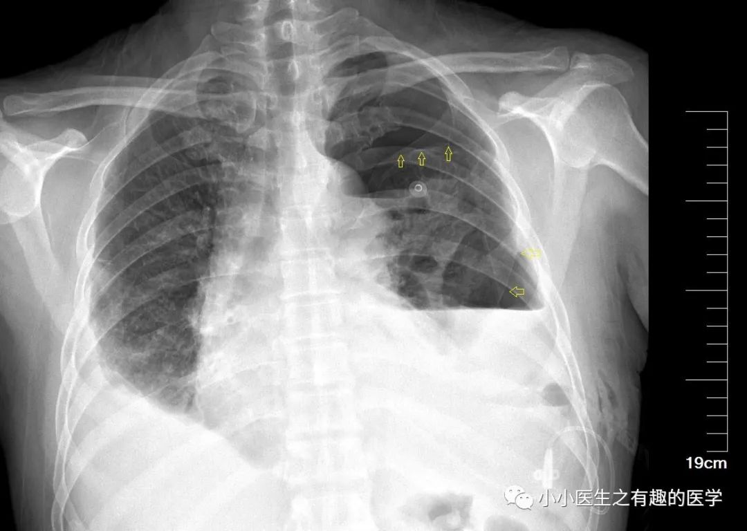 50%的氣胸氣體到底有多少?_醫學界-助力醫生臨床決策和職業成長