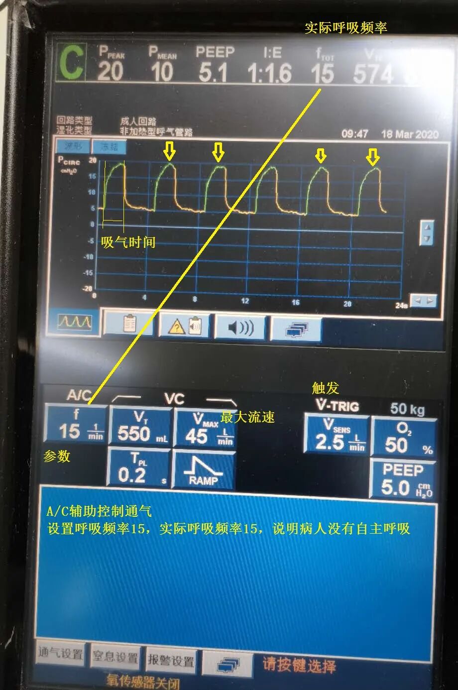 呼吸机怎么看呼吸重症：从呼吸机波形看自主呼吸_https://www.jmylbn.com_新闻资讯_第3张