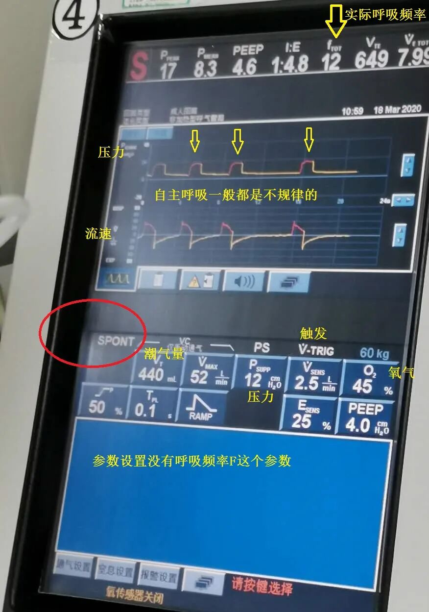 呼吸机怎么看呼吸重症：从呼吸机波形看自主呼吸_https://www.jmylbn.com_新闻资讯_第2张