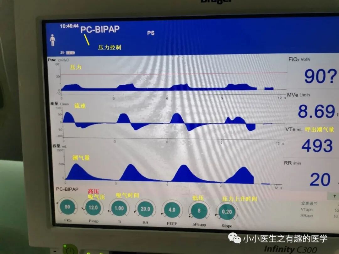 什么是 bipap呼吸重症：变态，BiPAP与BIPAP是两种完全不同的模式_https://www.jmylbn.com_新闻资讯_第12张