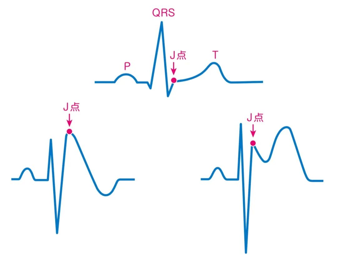 心电图纸怎么看心电图纸上跳动的线条，你了解多少？_https://www.jmylbn.com_新闻资讯_第12张