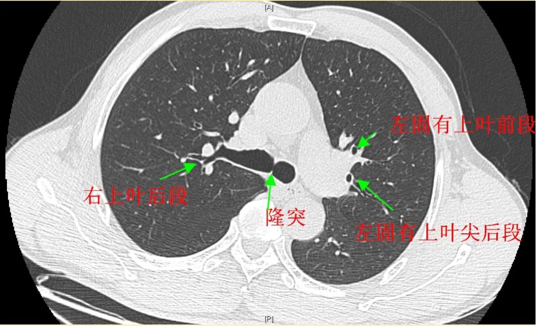 三曲目支氣管鏡基本操作有了前面的肺臟解剖和胸部ct影像學的理論鋪墊