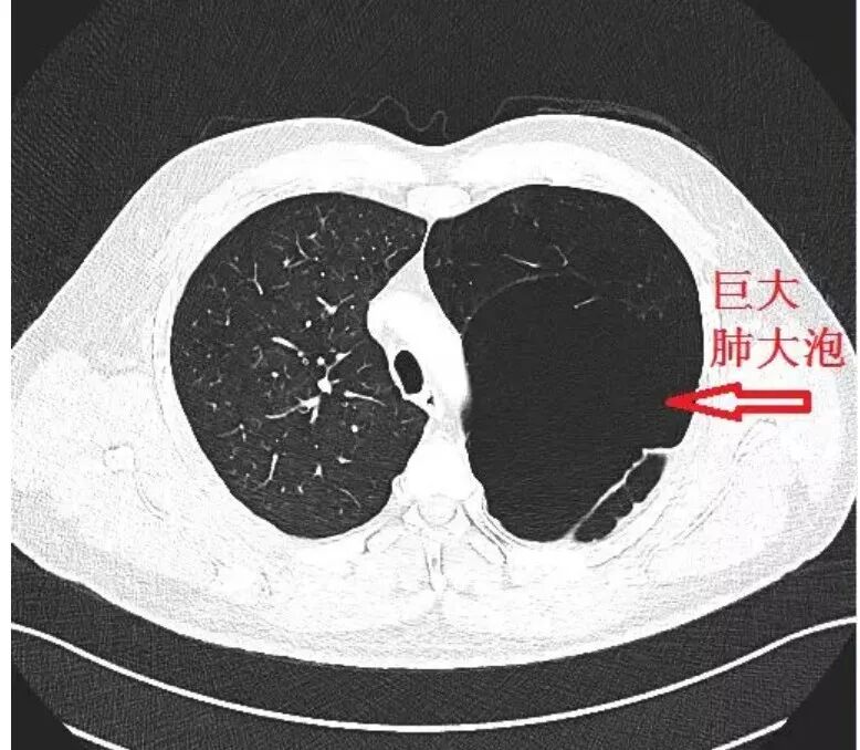 包裹性气胸 or 肺大泡?3个精彩病例带你学会分清!