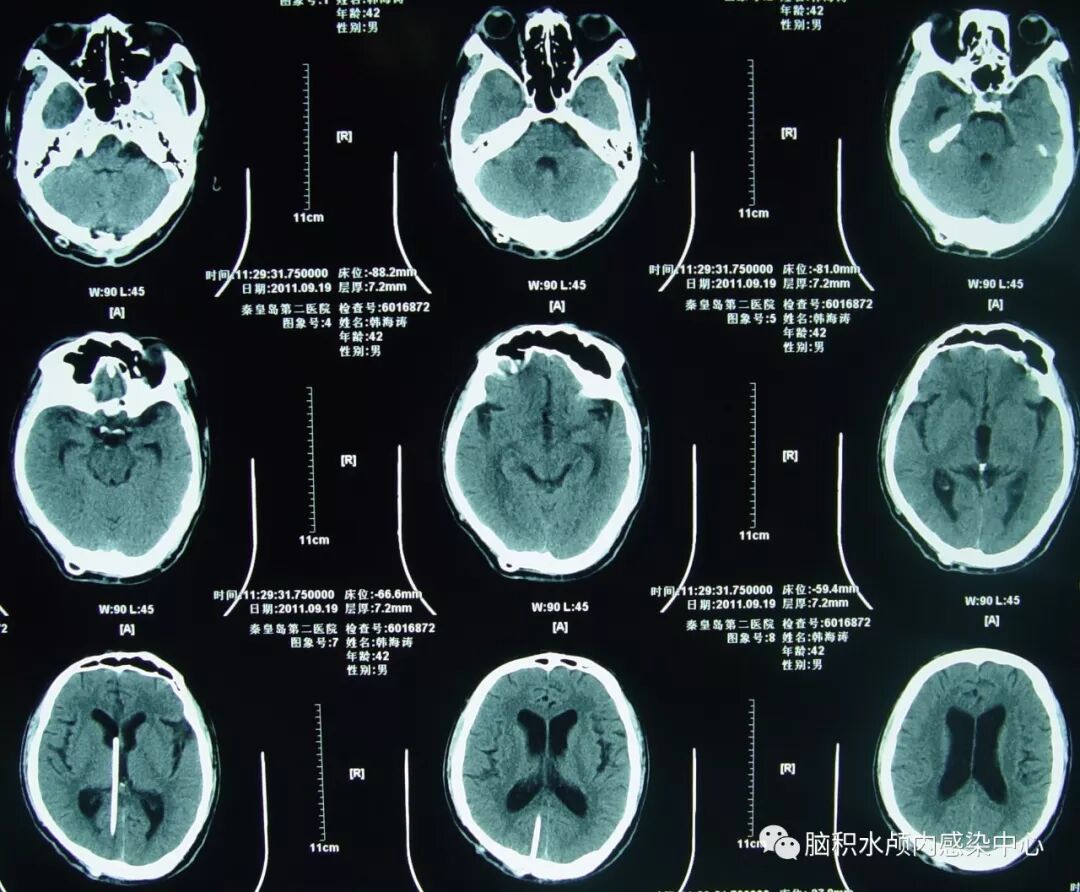 脑脊液科治愈一例小脑扁桃体下疝脊髓空洞枕下减压术后假性脑 - 好