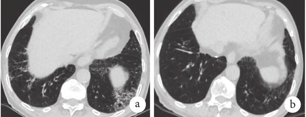abp 统计怎么做变应性支气管肺曲霉病临床特点及基础疾病分析_https://www.jmylbn.com_新闻资讯_第7张