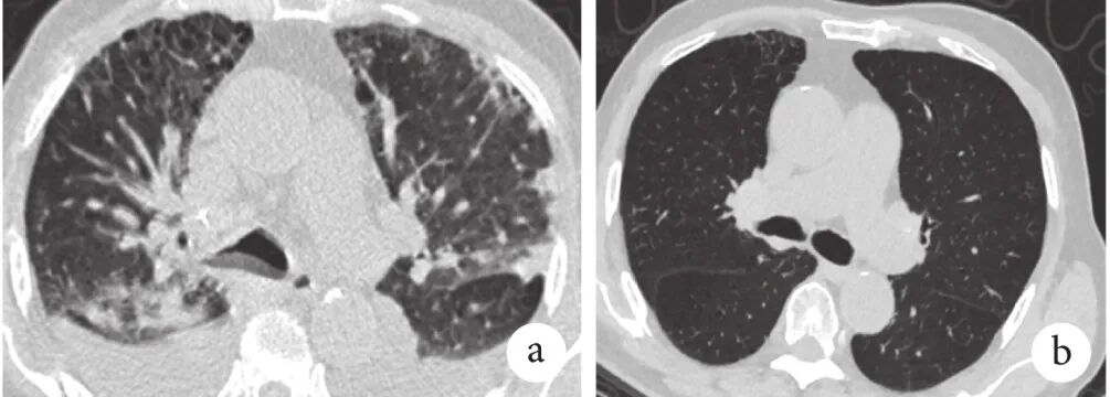 abp 统计怎么做变应性支气管肺曲霉病临床特点及基础疾病分析_https://www.jmylbn.com_新闻资讯_第6张